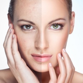 Φωτοανάπλαση